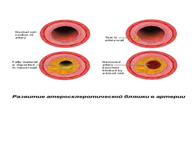 Развитие атеросклеротической бляшки в артерии